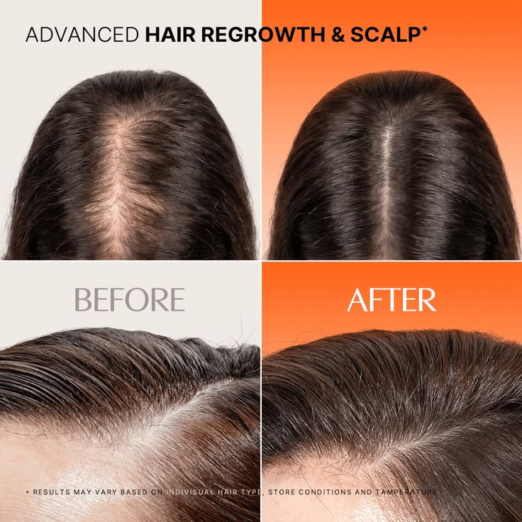 Before and progress comparison of a thinning centre part and fuller-looking hair coverage
