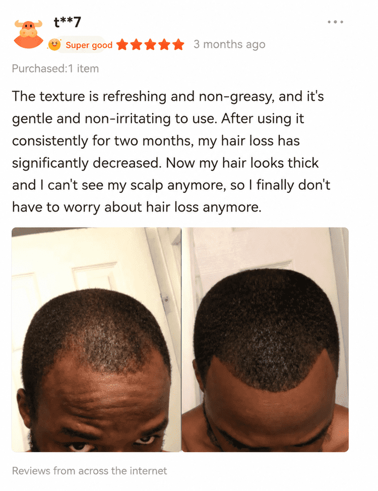 Black man showing hairline progress in a customer comparison